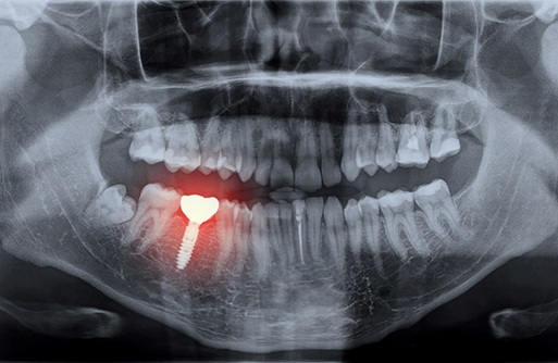 Highlighted X-ray representing failing dental implant in St. Augustine 