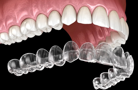 A digital image of an Invisalign clear aligner going on over the top row of teeth to address a bite alignment issue