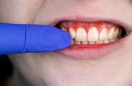 Closeup of bleeding gums