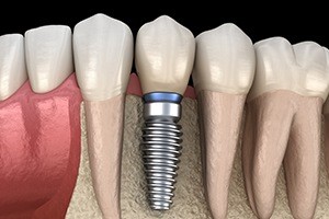 Animated dental implant supported dental crown