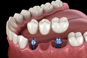 Animated dental implant supported fixed bridge