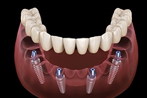 Animated dental implant supported denture