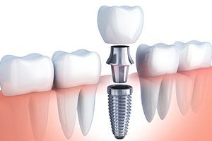 Animated parts of dental implant tooth replacement process