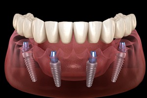Model of an implant denture for lower arch