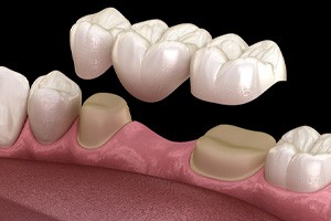 Digital illustration of dental implant bridge