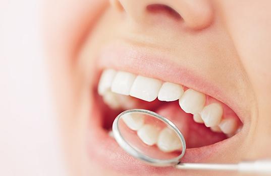 Closeup of tooth-colored fillings in St. Augustine