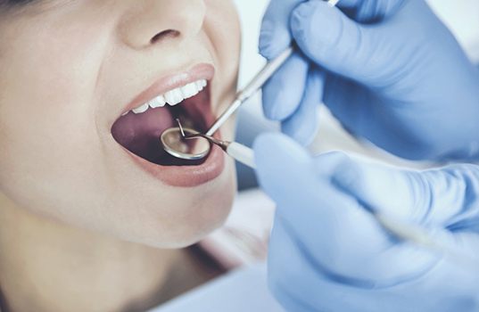 Closeup of dentist placing tooth-colored fillings