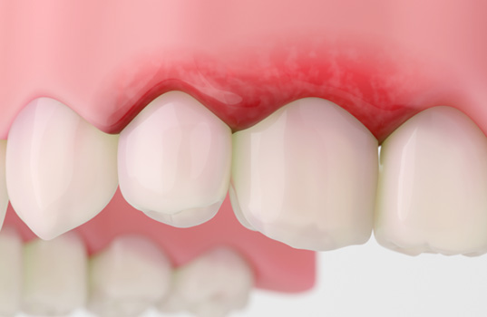 Illustration of inflamed gums as sign of gum disease in St. Augustine