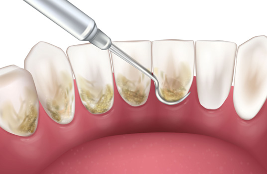 Illustration of scaling and root planing
