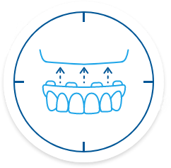 Animated implant denture being placed in upper arch