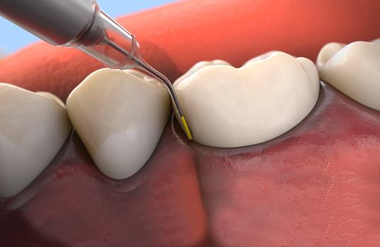 Animated arestin antibiotic therapy treatment procedure