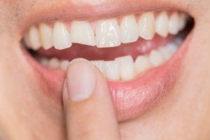 Smile with chipped front tooth