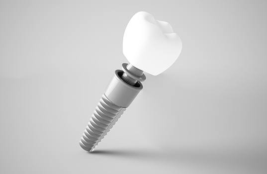 Animated dental implant supported dental crown