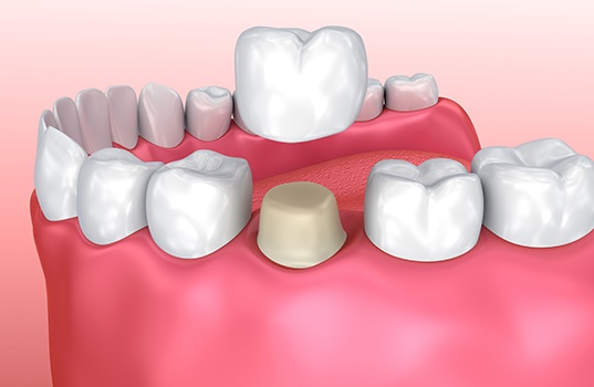 Animated metal free dental crown placement