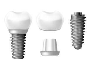 Illustration of different parts of dental implant in St. Augustine, FL