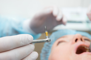 Closeup of dental implant before placed in patient’s mouth
