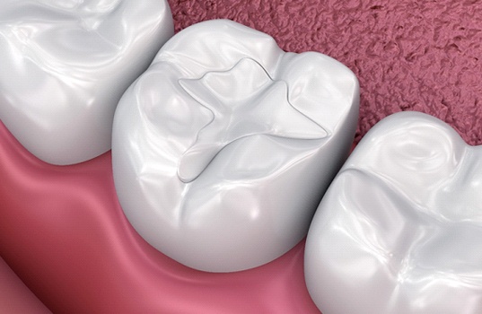 Digital model showing a dental sealant on molar