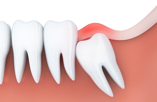 Animated smile with impacted tooth