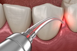 Dental laser fixing small teeth