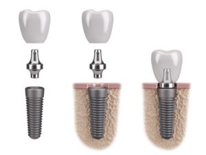 dental implant 3D illustration 