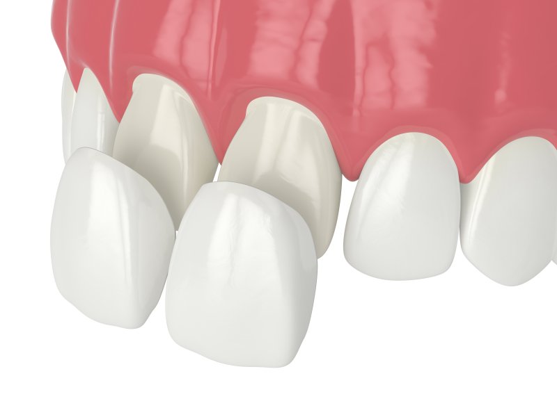 3D rendering of porcelain veneers