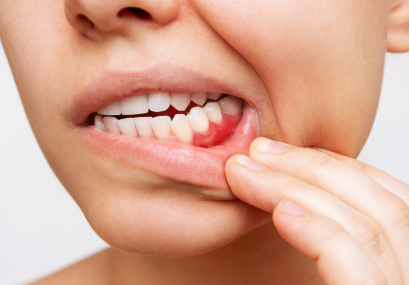 Woman showing inflammed gums